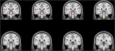 Vitamin C Acutely Affects Brain Perfusion and Mastication-Induced Perfusion Asymmetry in the Principal Trigeminal Nucleus